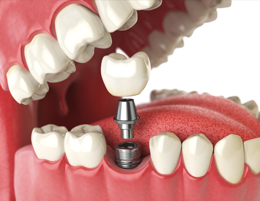 Dental-Implants2