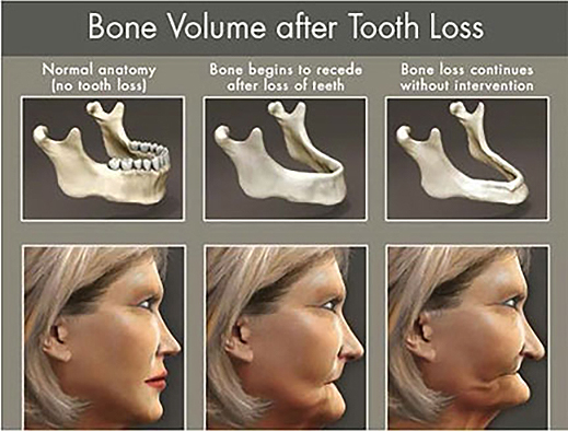 Family-Cosmetic-Dentistry-Dental-Inplant-Bones-Loss