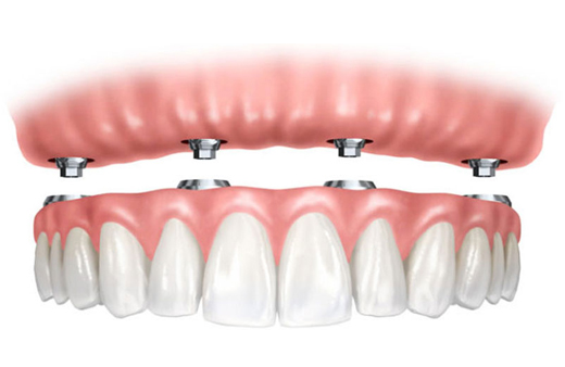 Family-Cosmetic-Dentistry-implants2