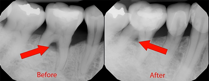 Laser-Dentistry-Before-and-After Laser Treatment Procedure