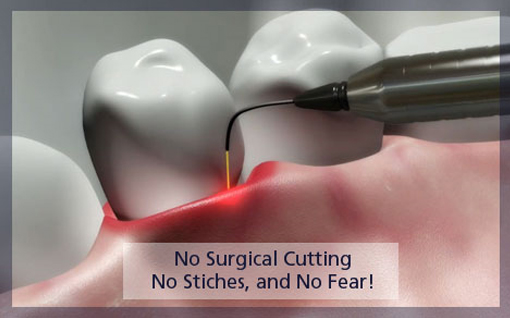 Laser-dentistry-----illustration