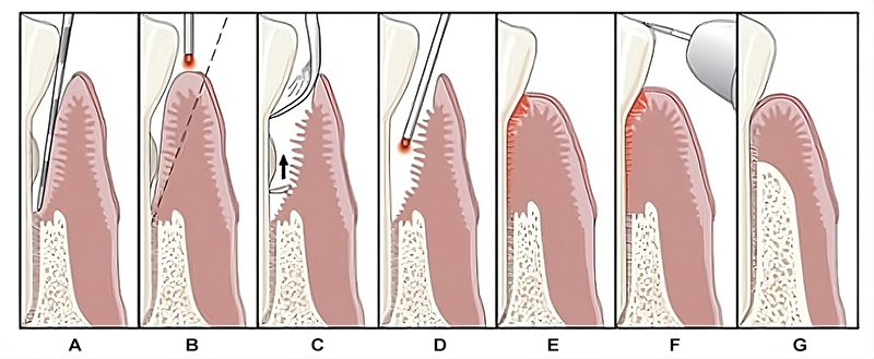 Laser Treatment Procedure Laser Treatment Procedure