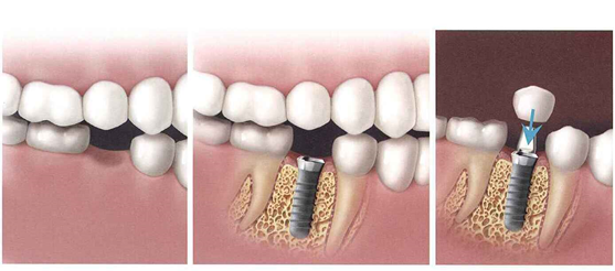 dental_implants_three png