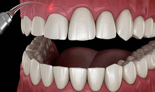 Gum Reshaping Gum Reshaping