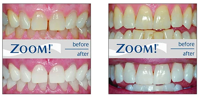 zoom-teeth-whitenng