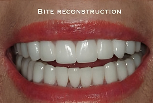 Full Mouth Construction After Full Mouth Construction After