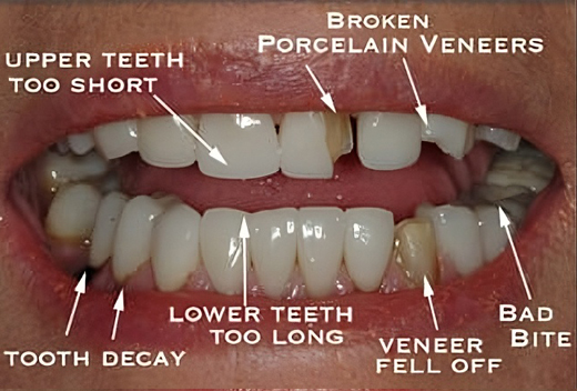 Full Mouth Construction Before Full Mouth Construction Before