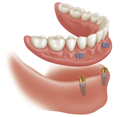 partial-dentures